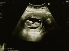 Ultrasound of baby at 12 weeks